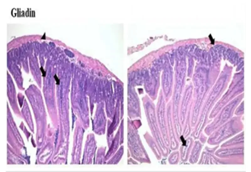 グリアジンで損傷された腸上皮細胞